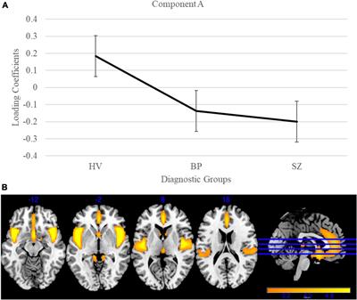 Clinical and cortical similarities identified between bipolar disorder I and schizophrenia: A multivariate approach